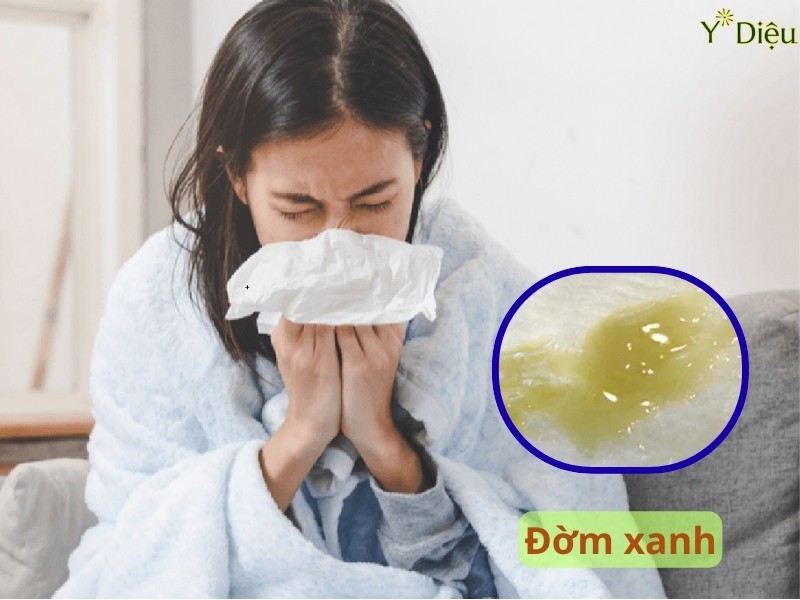 Viêm phổi cấp tính có thể gây ra ho khan hoặc ho có đờm xanh hoặc trắng.